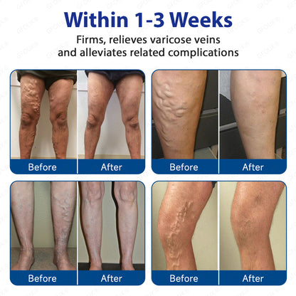 ⚡✅GFOUK® VeinTarget Microneedle Patch👨🏼‍⚕️Instant Relief, Long-Term Results