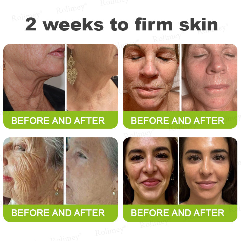 Made and shipped from the UK Rolimey® 💰 Botox & Vita-A Retinol Shot Wrinkle-Lift Tightening cream - Last Day Promotion 70% OFF |✅