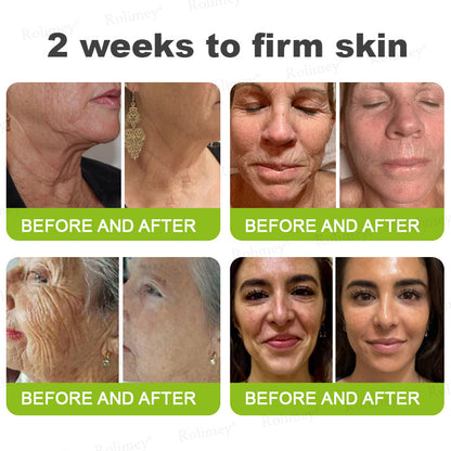 Made and shipped from the UK Rolimey® 💰 Botox & Vita-A Retinol Shot Wrinkle-Lift Tightening cream - Last Day Promotion 70% OFF |✅