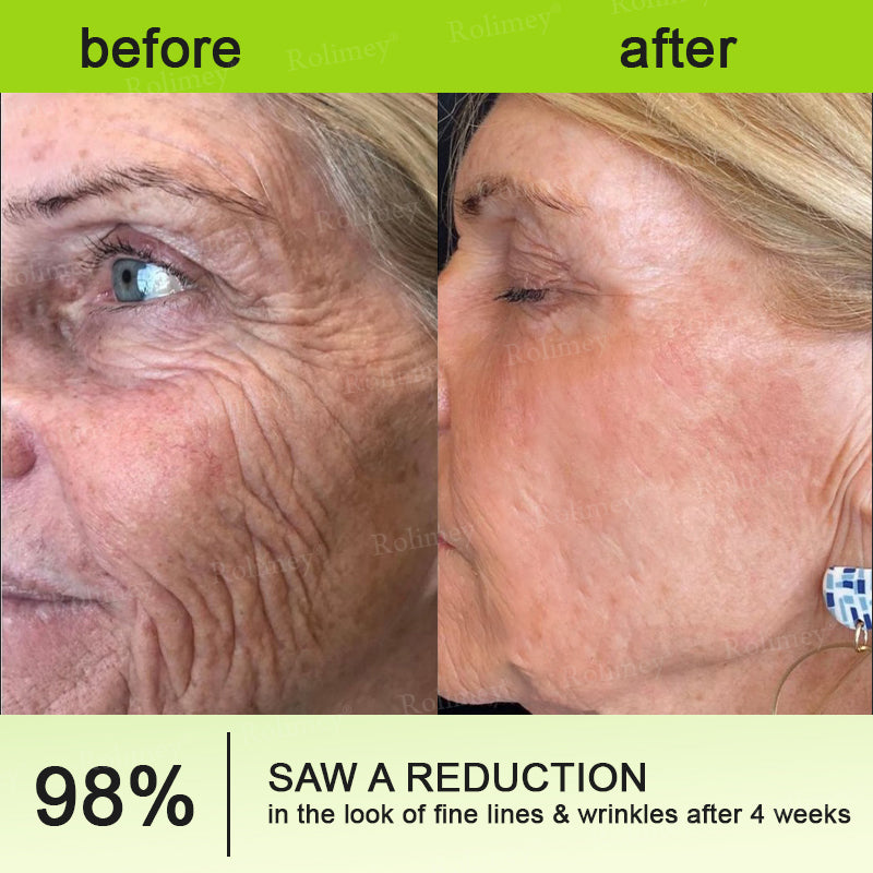 Made and shipped from the UK Rolimey® 💰 Botox & Vita-A Retinol Shot Wrinkle-Lift Tightening cream - Last Day Promotion 70% OFF |✅