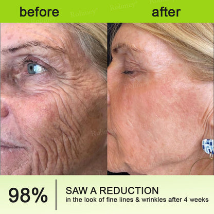 Made and shipped from the UK Rolimey® 💰 Botox & Vita-A Retinol Shot Wrinkle-Lift Tightening cream - Last Day Promotion 70% OFF |✅