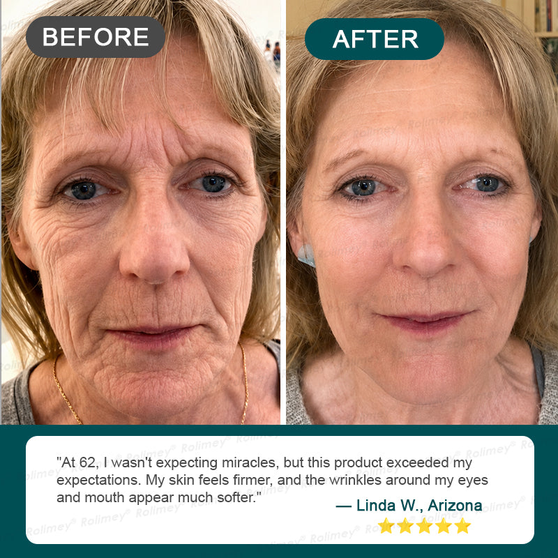 ✨ Rolimey® Botox & Stem Cell Wrinkle-Lift Tightening Cream (upsell)