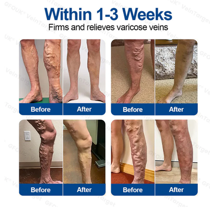 ⚡✅GFOUK® VeinTarget Microneedle Patch👨🏼‍⚕️Instant Relief, Long-Term Results